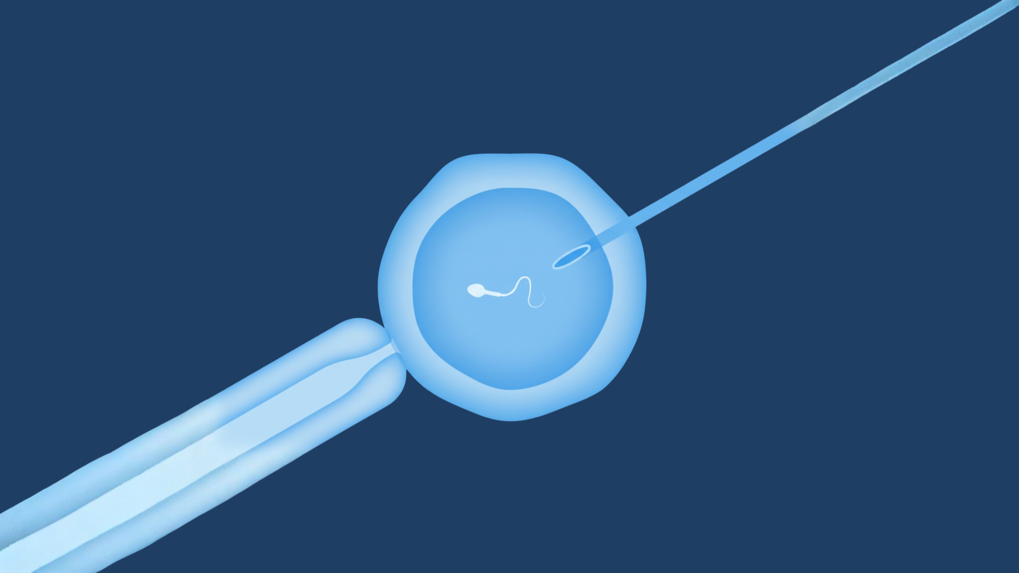 Icsi intra cytoplasmic sperm injection